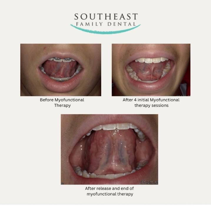 Southeast Family Dental before and after photos of tongue and lip ties