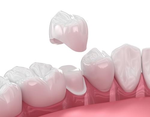 An illustration of a dental crown going onto a tooth