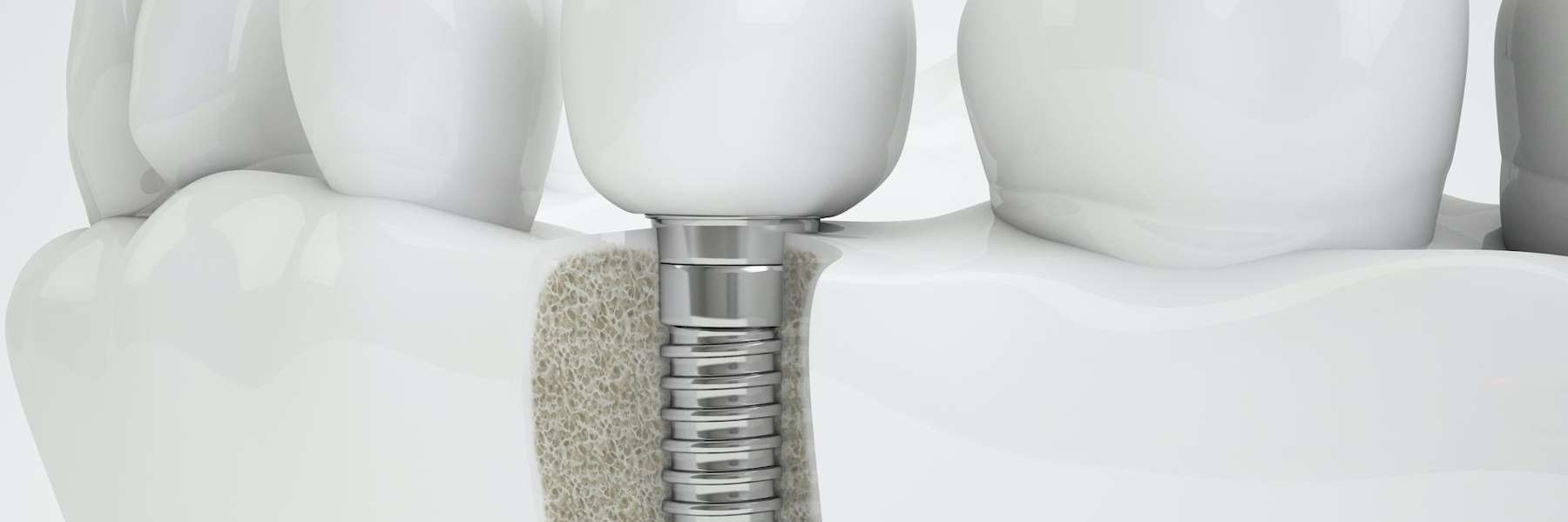An illustration of a dental implant and screw in a jaw bone