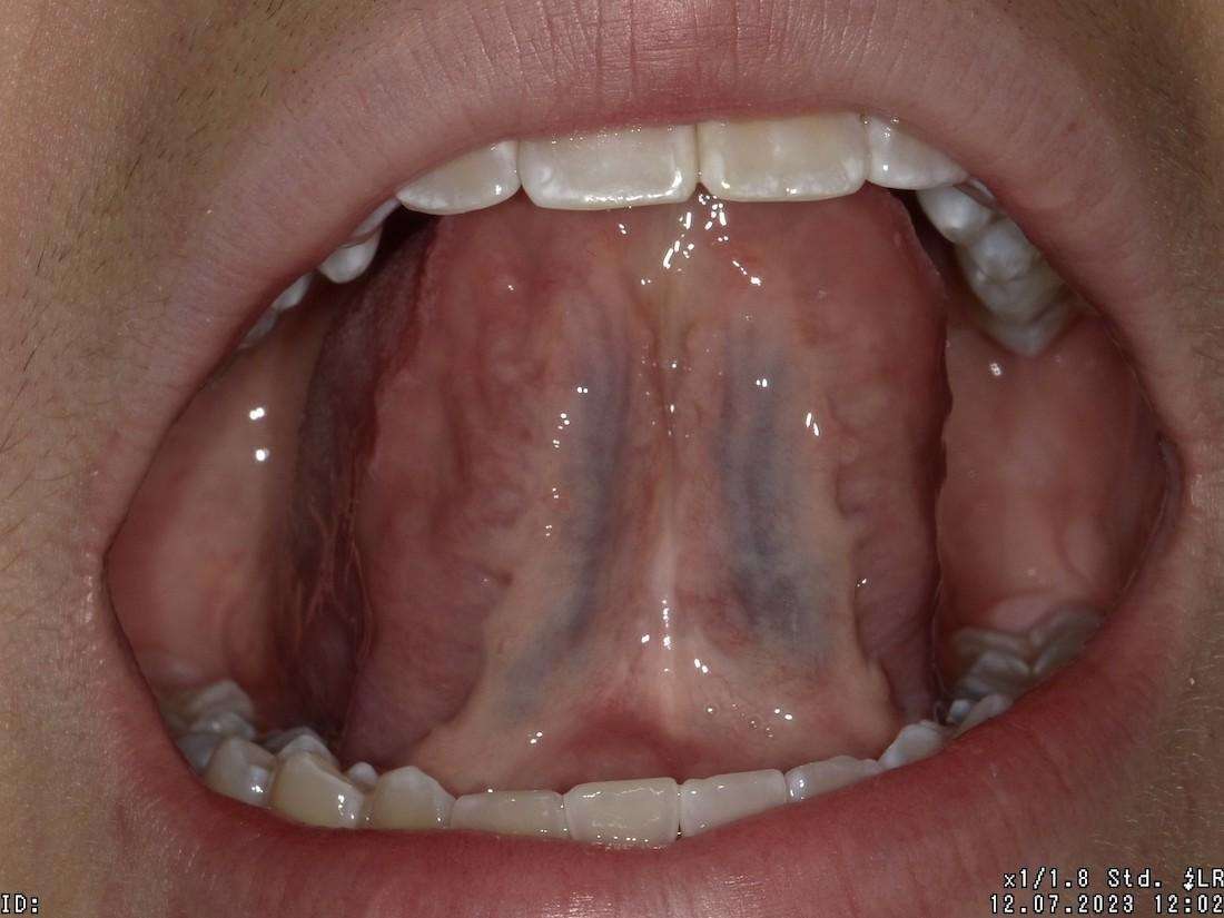 Young patient after getting tongue tie treatment at Southeast Family Dental