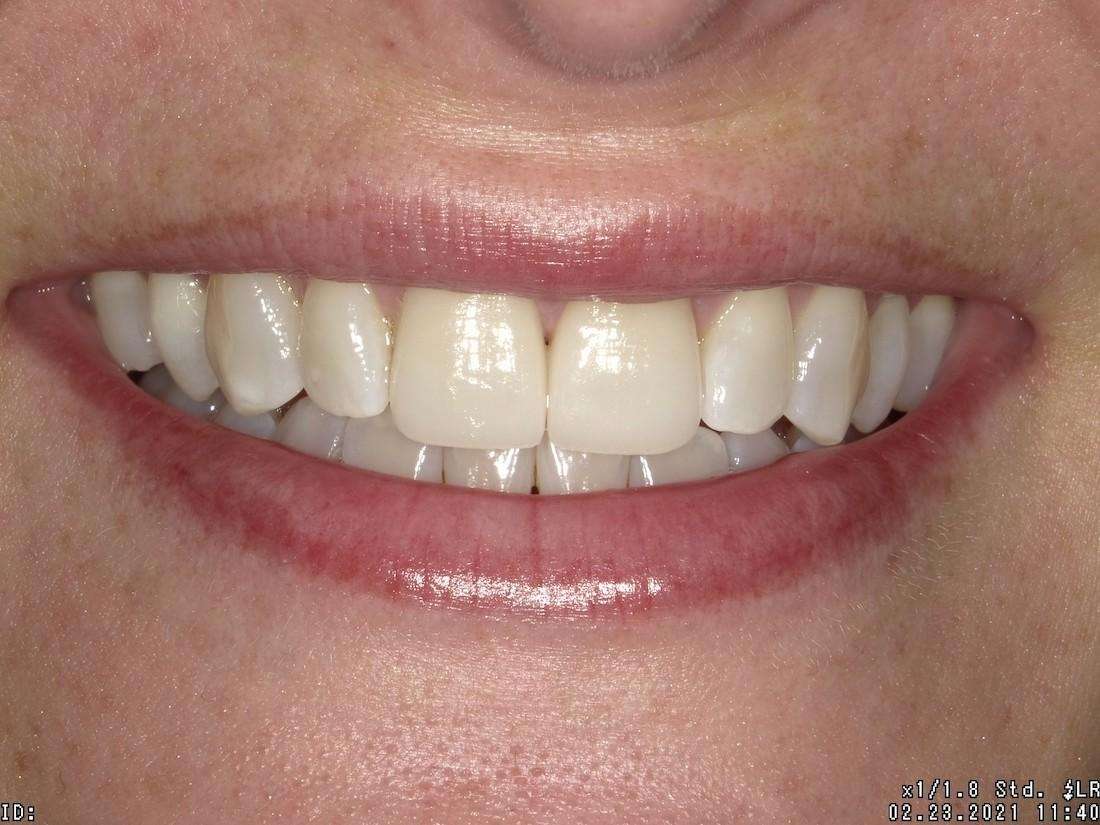Patient teeth after dental bonding to replace veneers in Indianapolis