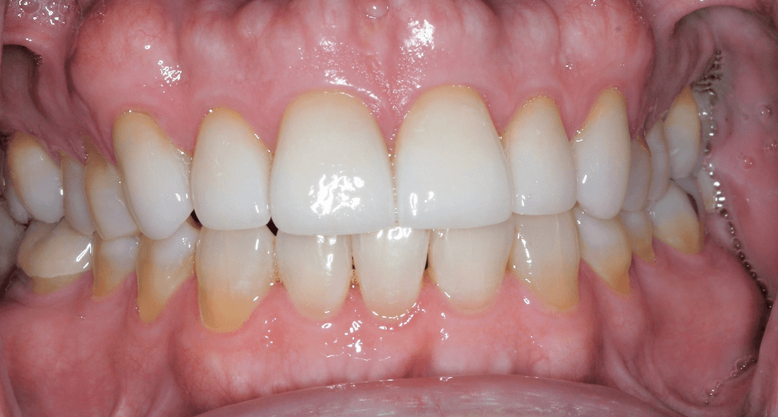 Patient teeth after getting veneers at Southeast Family Dental