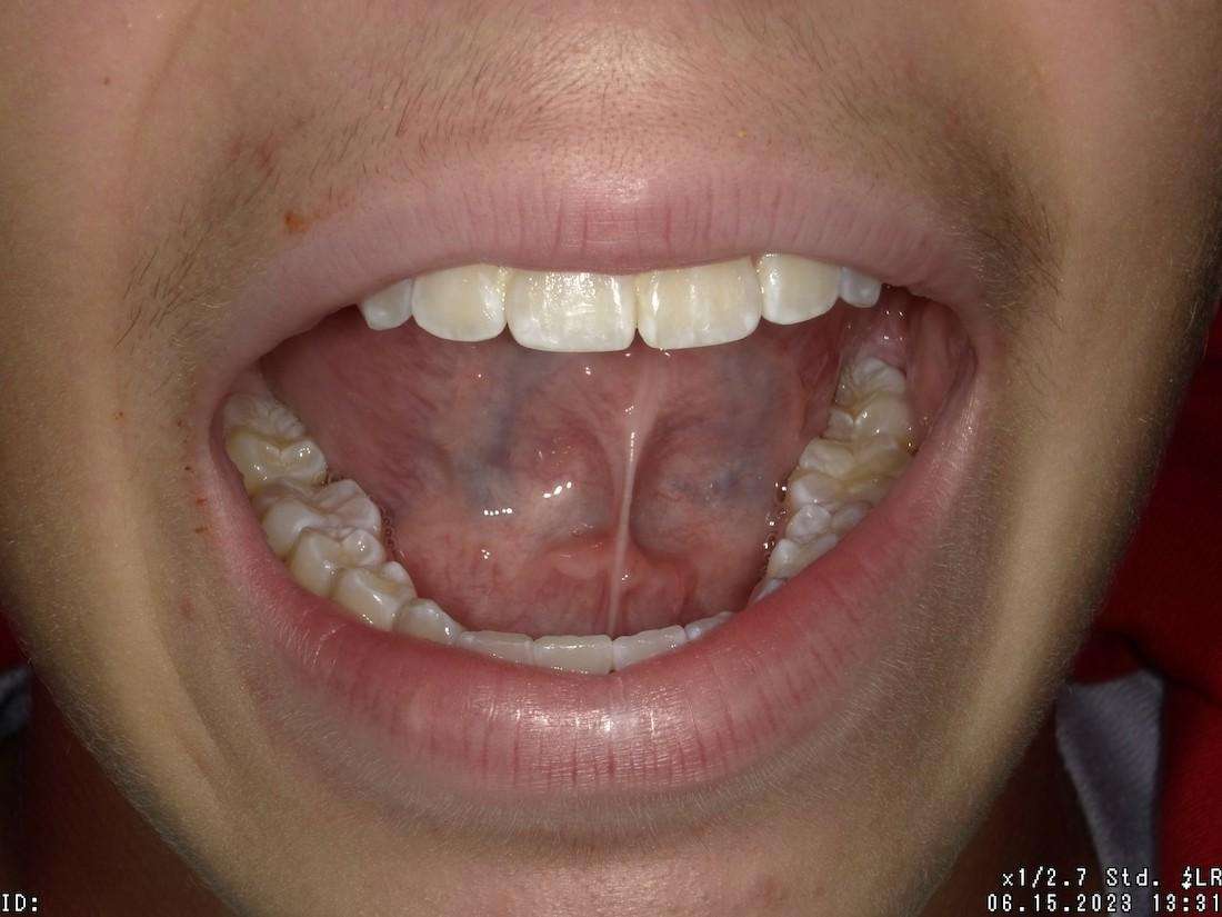 Young patient with tongue tie in Indianapolis