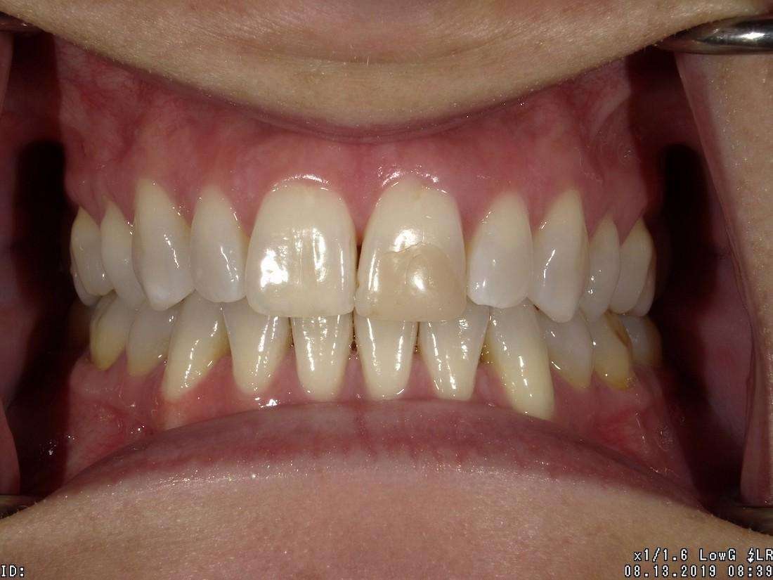 Patient teeth before veneers