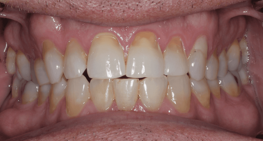 Patient smile before getting porcelain veneers