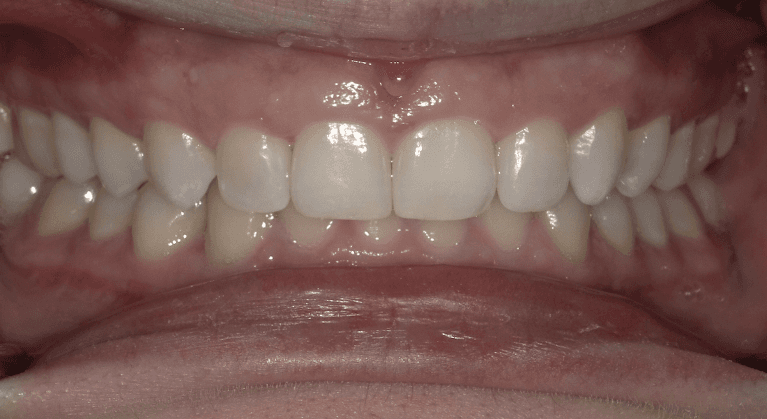 Southeast Family Dental patient after receiving Invisalign