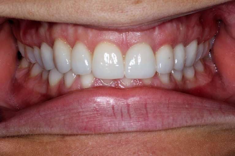 Patient teeth after crown lengthening and new crowns in Indianapolis