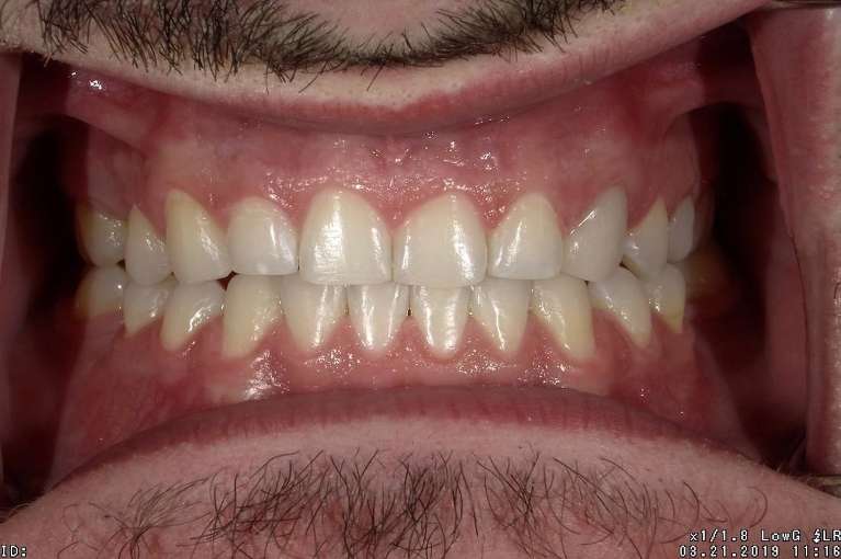 Teeth-Whitening-Ortho-After-Image