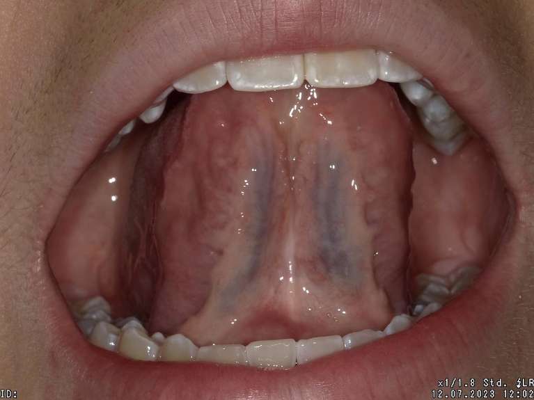 Tongue-Tie-After-Image