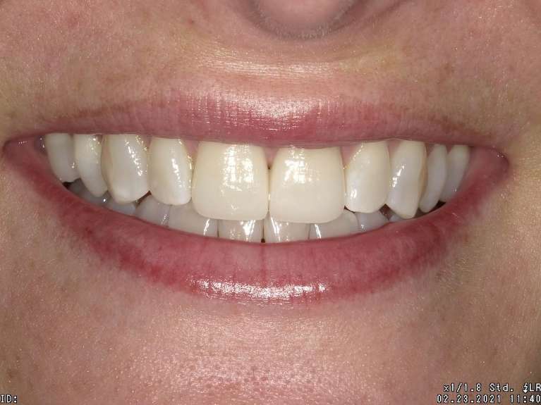 Porcelain-Veneers-After-Image