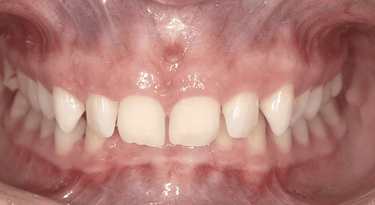 Patient teeth before clear aligners in Indianapolis