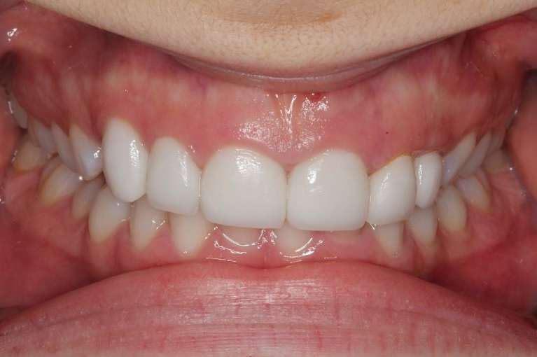 Dental patient before new crowns