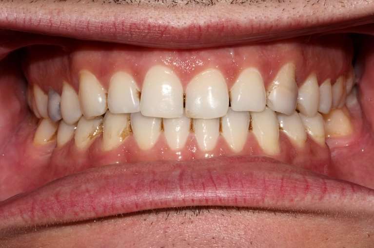 Teeth-Whitening-Ortho-Before-Image