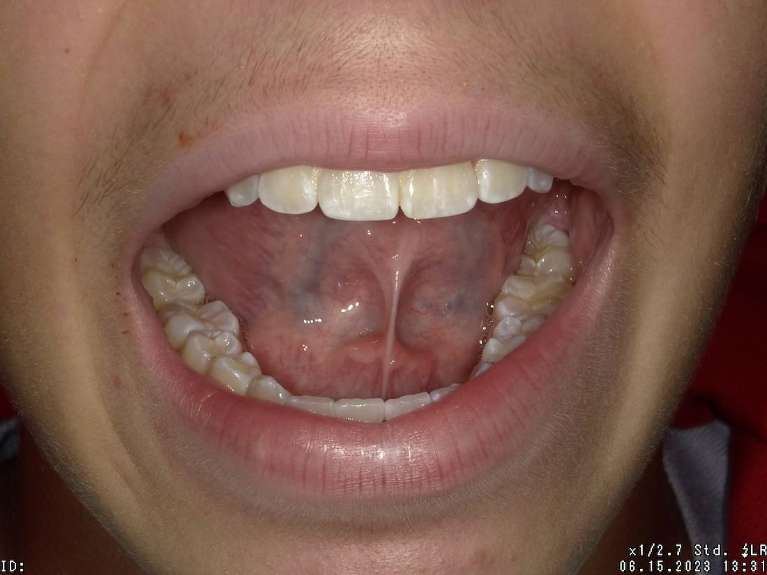 Tongue-Tie-Before-Image