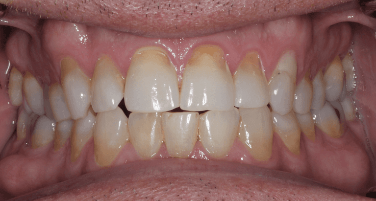 Porcelain-Veneers-Before-Image
