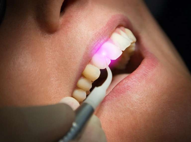A dental laser being used to perform precise dental treatments in Indianapolis